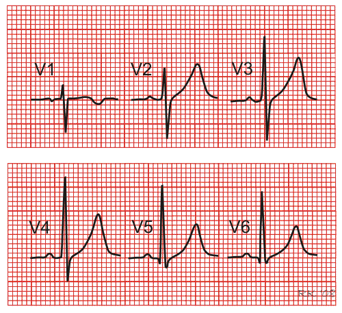 electrocardiogram chest lead tracings