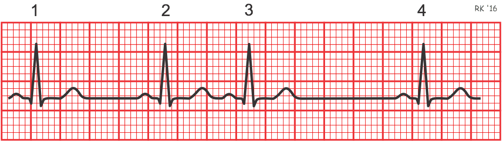 electrocardiogram rhythm strip