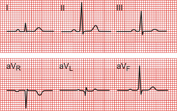 electrocardiogram limb lead tracings