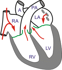 cardiac anatomy - reduced ejection