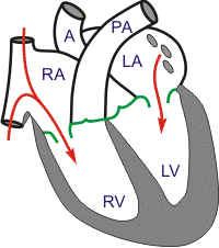 cardiac anatomy - reduced filling