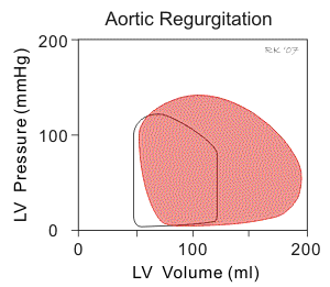 effects of aortic regurgitation on ventricular pressure-volume loops