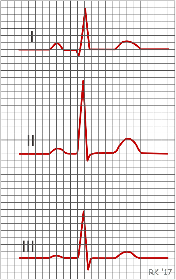 ECG bipolar lead recordings