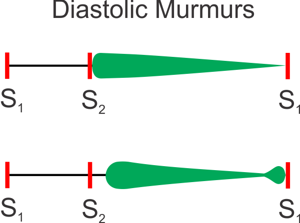 Diastolic murmurs