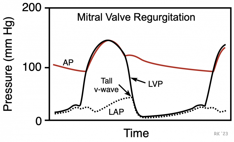 Mitral regurgitation catheter pressure