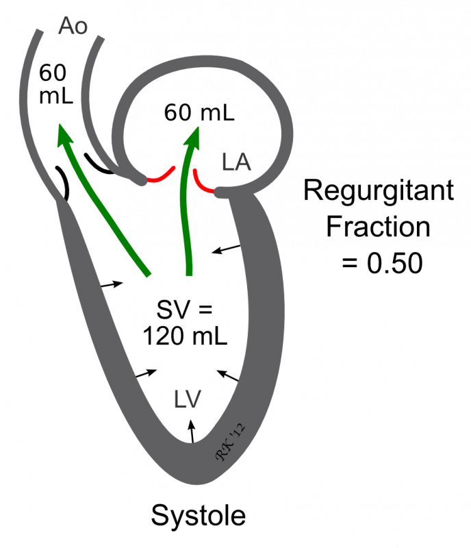 Regurgitant fraction in mitral valve insufficiency