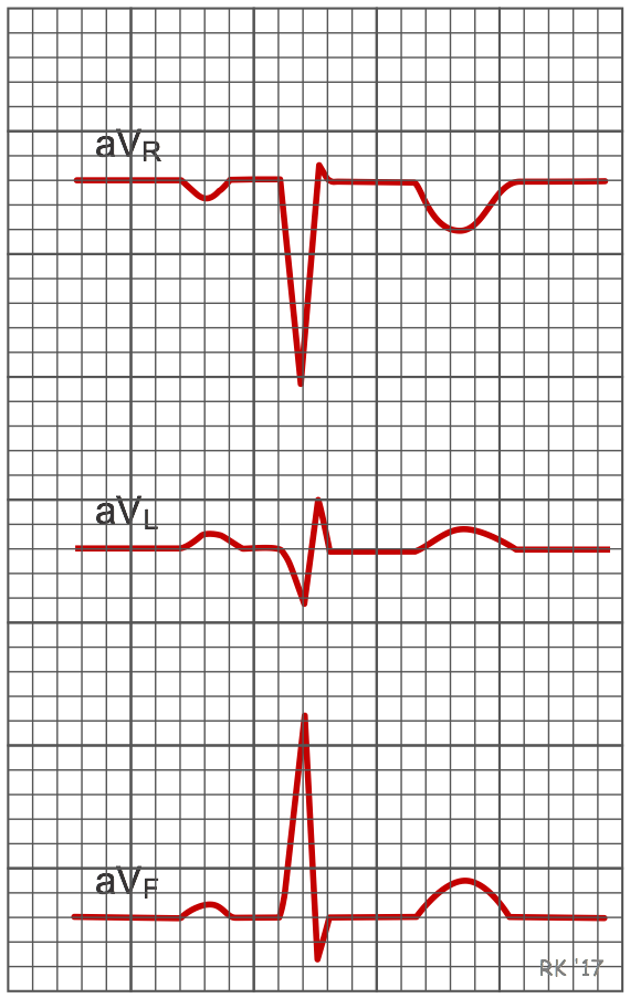 ECG augmented lead tracings