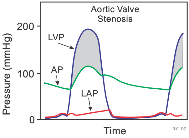 Aortic stenosis catheter pressure tracings