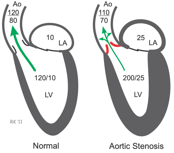 Aortic stenosis chamber pressures