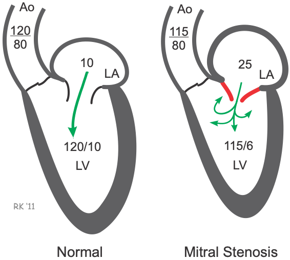 mitral stenosis cardiac pressures