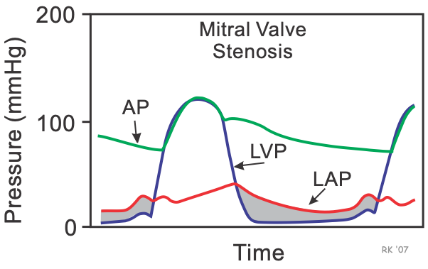 mitral stenosis catheter pressure tracings