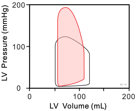 Aortic stenosis pressure-volume loop